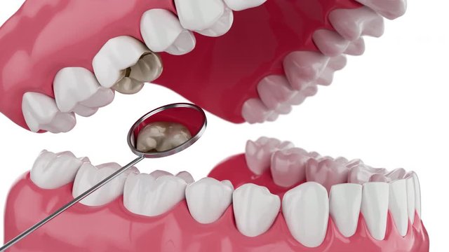 Slow motion Closeup Decayed tooth with Mouth mirror 3D Animation with alpha mate. 4K