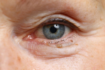 Old woman eye closeup pojrtrait. Cataract treatment medical concept. Vision dysfunction laser...