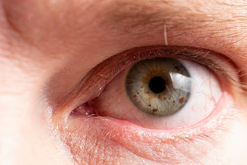Sore eye with suppuration on eyelashes closeup