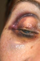 A bruise near the eye. Hematoma on the face from a blow. Eye injury.