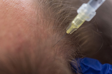 Hair loss treatments for men