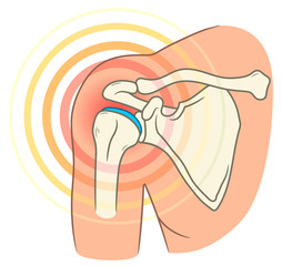 Shoulder joint pain