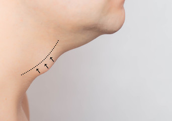 Marks in a man on an Adam's apple, reduction and removal of the Adam's apple in plastic surgery,...
