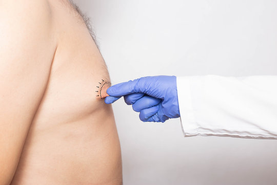 Dotkor plastic surgeon examines the nipples in the male patient for surgery to correct and change the shape of the nipple, anaplasty