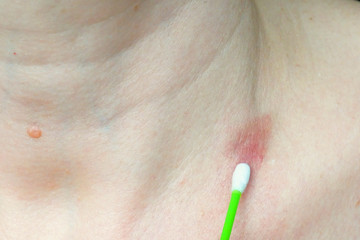 skin rash treatment on woman neck. Shingles, Disease, Herpes zoster, varicella-z, lichenoid...