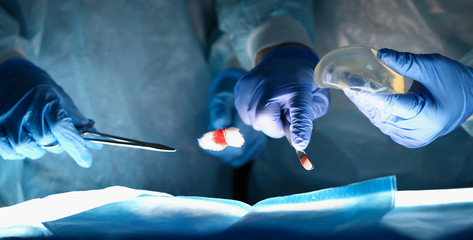 Close-up of physicians hands performing medical breast reconstruction procedure. Specialist holding silicone implants in hand. Breast augmentation concept - obrazy, fototapety, plakaty