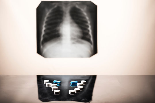 tuberculosis treatment concept. X-ray of the lungs, with pathology, phonendoscope with pills on the table.