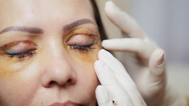 A doctor in white gloves examines a patient's face after blepharoplasty of the eyelids