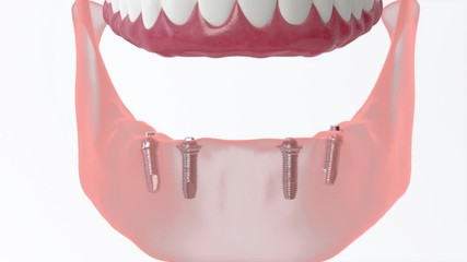 All on 4 system supported by implants, screw fixation. Medically accurate 3D illustration of dental concept