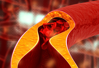 Atherosclerosis, Cholesterol plaque in artery. 3d illustration.