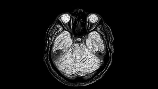 Voluminous MRI scans of the brain and head to detect tumors. Diagnostic medical tool