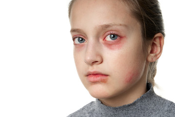 Allergic reaction, skin rash, close view portrait of a girl's face. Redness and inflammation of the...