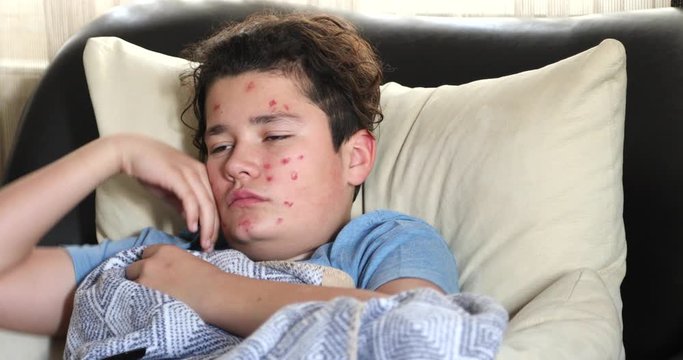 Portrait of a tired young boy suffering from chicken pox rash scratching his face, lying on sofa and watching television