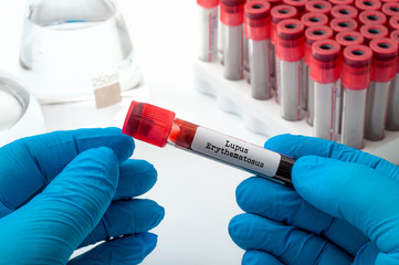 Science, medicine and pharmacy concept with doctor performing blood test on medical sample while...