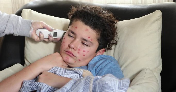 Portrait of a tired young boy suffering from chicken pox rash scratching his face, lying on sofa and watching television