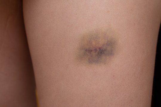 Detail of forearm with a big bruise