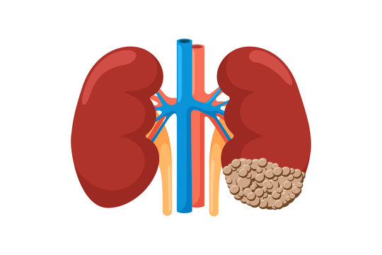 Healthy and sick kidney with cancer. Human anatomy genitourinary system internal unhealthy tumor neoplasm organ and strong compare. Vector oncology flat illustration