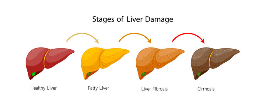 Stages of liver damage. Liver Disease. Healthy, fatty, fibrosis and Cirrhosis. Info-graphic, vector illustration isolated on white background.