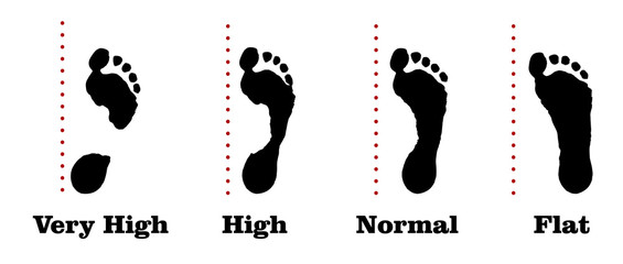 Flatfoot. 4 footprints of a person with varying degrees of flat feet. - obrazy, fototapety, plakaty