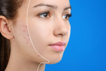 Teenage girl before and after acne treatment on blue background