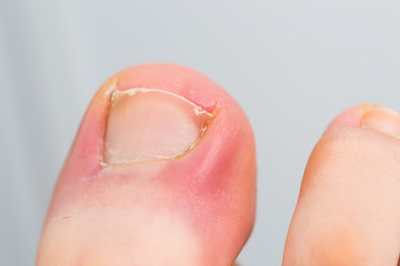 close-up photo of a toenail infection in human