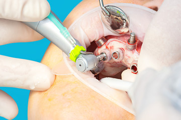 Close up of digital guided implant surgery on patient - new implant technology in dentistry. - 317299846