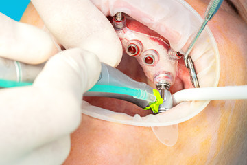 Close up of digital guided implant surgery on patient - new implant technology in dentistry.