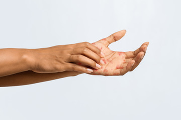 Afro woman having eczema on her palm