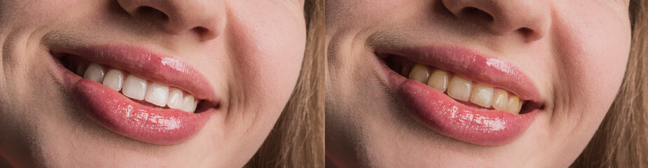 Teeth whitening at the dentist. Stomatology and dental clinic concept. Before and after. White...