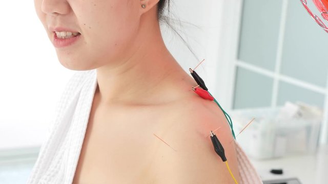 Asian woman receiving acupuncture with electric stimulation at shoulder in a hospital,Chinese alternative medicine concept.