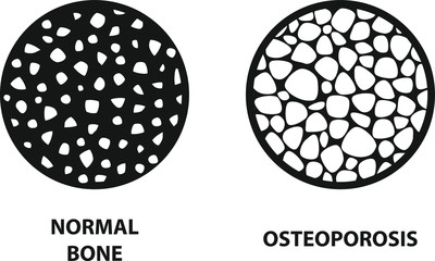 Osteoporosis icon ,Bone structure, vector illustration