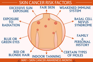 Skin cancer risk factor infographic vector illustration. Health and healthcare concept design for presentation, banner, brochure, etc. EPS-10 vector, printable cmyk colors.