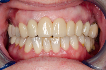 keramikkronen auf zirkonoxid basis in der oberkiefer front