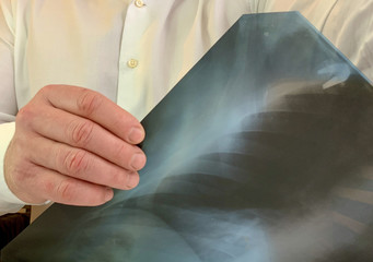 A doctor in a white shirt looks at an x-ray. A man holds a chest x-ray in his hands. Concept:...