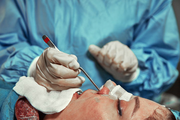 A surgeon with gloves is operating on his nose. Rhinoplasty, close-up operation. Blue light, teamwork, health, beauty.