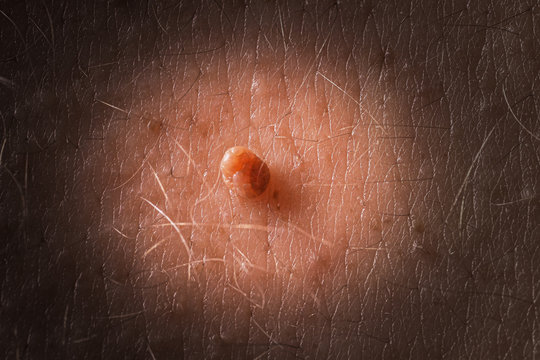 Skin tag or acrochordon on male back, macro photo. Papilloma virus or bump, dermatology problem on skin concept.