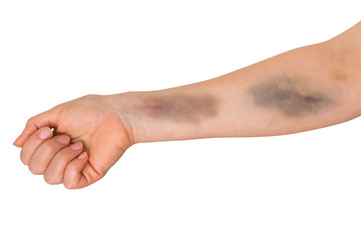 Large bruise on human arm. Domestic violence.