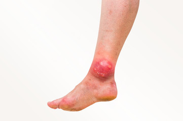 Red rash on leg of patient who was bitten by an insect