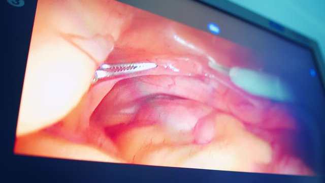Robotic surgical system da Vinci. Modern equipment in operating room.