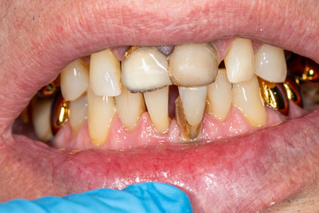 Close-up of macro dental calculus and dental plaque. Oral hygiene in dentistry