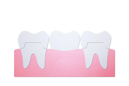 dental crown with bridge, installation process and change of teeth - tooth cartoon paper cut style