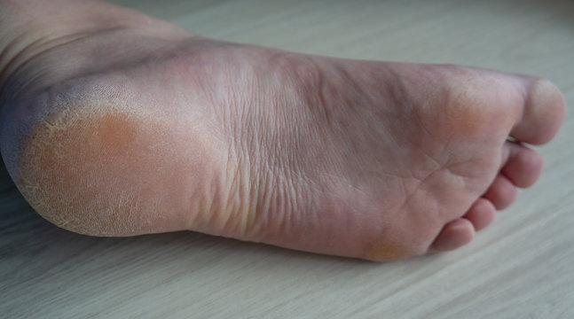 Sole of foot with cracked skin and yellow callus. Wrinkels in the arch and overall worn and damaged look. Concpetual for tired, worn or pain. Can be used for medical purposes.