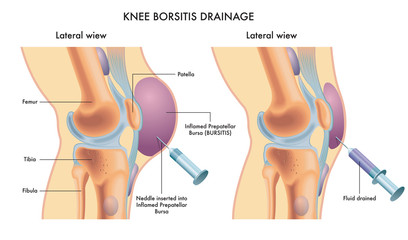 Labelled medical illustration showing knee bursitis drainage procedure.