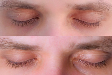 Obraz premium Closed eyes of young man patient before and after laser removal of papillomas on eyelids or skin growths, closeup. View a week later after making laser removing. Result of surgical cure.