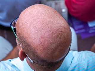 baldness head from man close up - obrazy, fototapety, plakaty