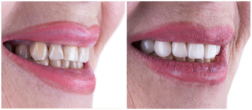 before and after picture for dental tratment done by press ceramic crowns and veneers