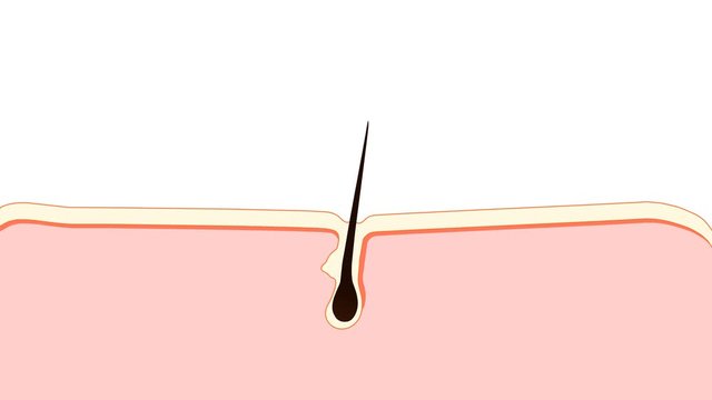 Laser Hair Removal. The laser emits an invisible light which penetrates the skin without damaging it. At the hair follicle, the laser light absorbed by the pigments is converted into heat. 