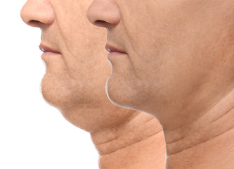 Mature man before and after plastic surgery operation on white background, closeup. Double chin...