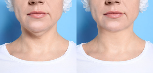 Mature woman before and after plastic surgery operation on blue background, closeup. Double chin...