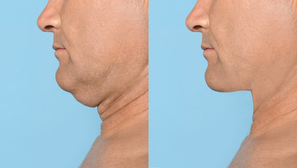 Mature man before and after plastic surgery operation on blue background, closeup. Double chin...